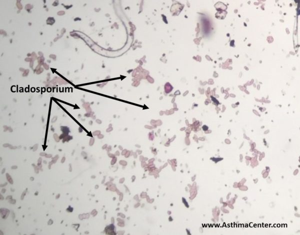 Mold Allergy and Cladosporium